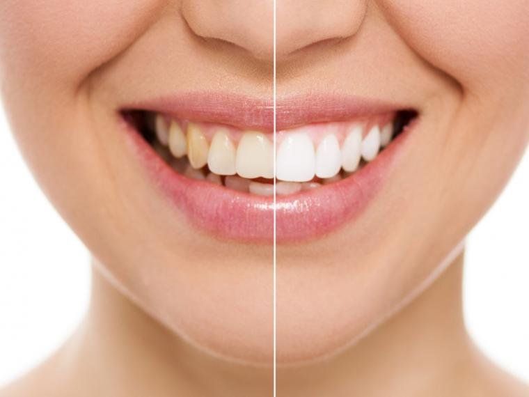 Come sbiancare i denti (con le strisce a casa funziona?) 1